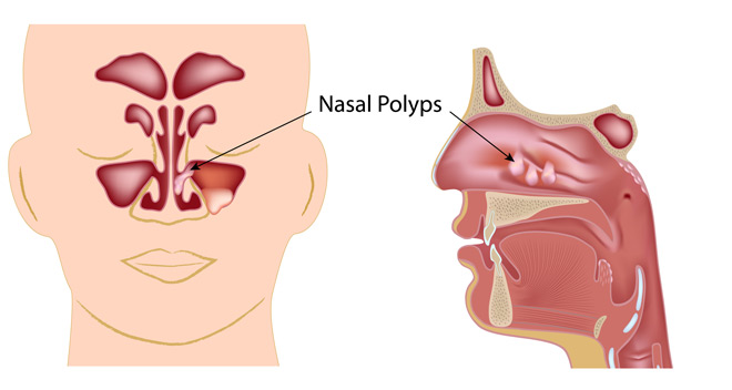 North Dallas specialists in ear nose and throat, ear nose and throat doctor Richardson, Dr. Morris Gottlieb, Minimally Invasive Sinus Surgery North Dallas, Endoscopic Sinus Surgery North Dallas, Chronic Sinusitis North Dallas, Balloon Sinuplasty North Dallas, Ear nose and throat specialist North Dallas, Ear nose and throat specialist Richardson, hearing aids Plano, hearing aids Richardson, hearing aids North Dallas, hearing tests Plano, hearing tests Richardson, hearing tests North Dallas, North Dallas ENT specialists