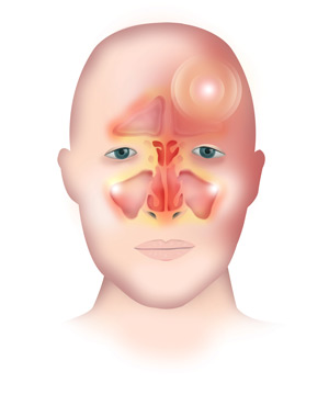 Sinus of store the head